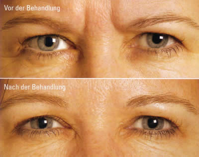 Kosmetische Dermatologie Botox-Frau vor_nachher 2.jpg