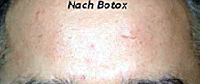 Kosmetische Dermatologie_Botox-Mann nachher.gif